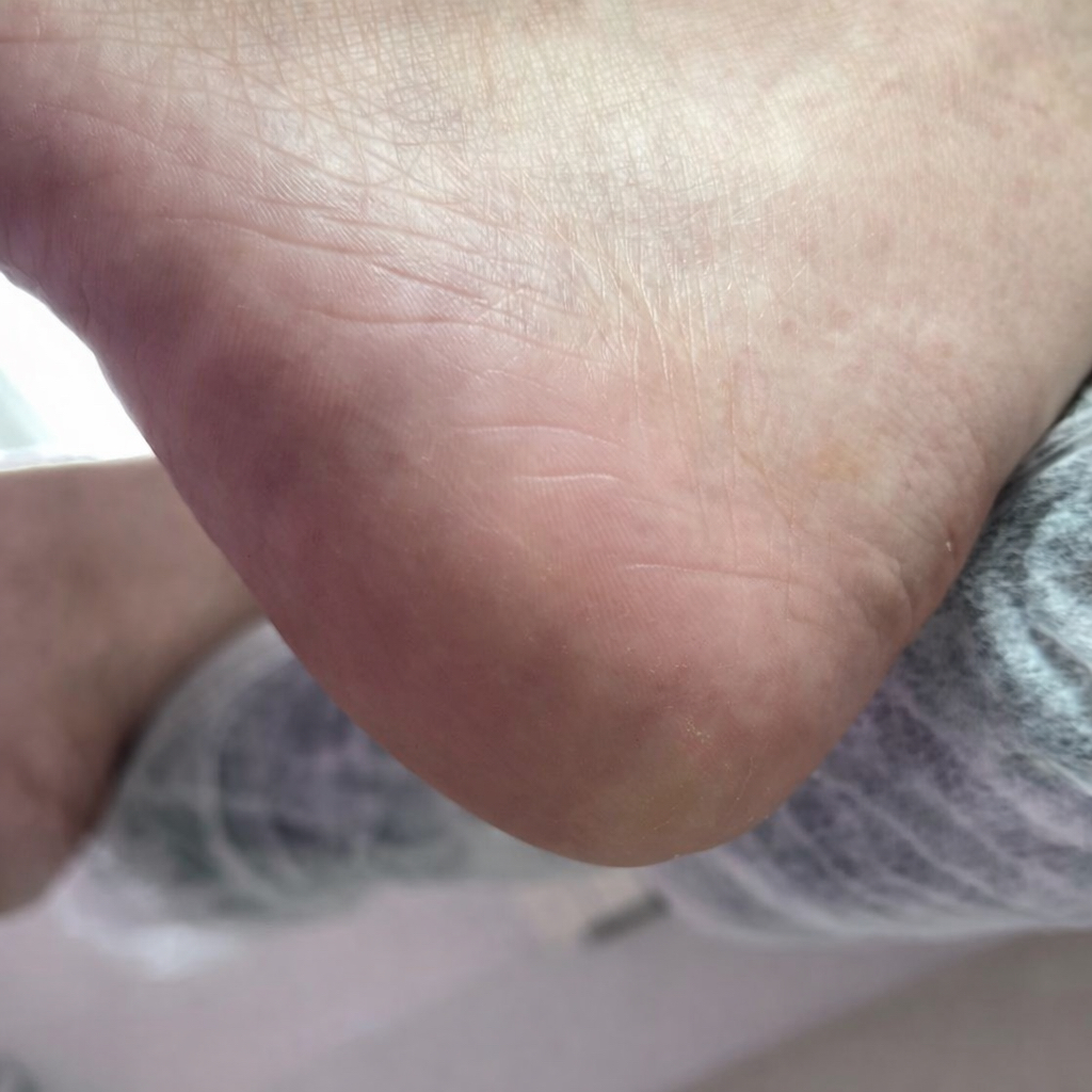 Medische pedicure - eelt