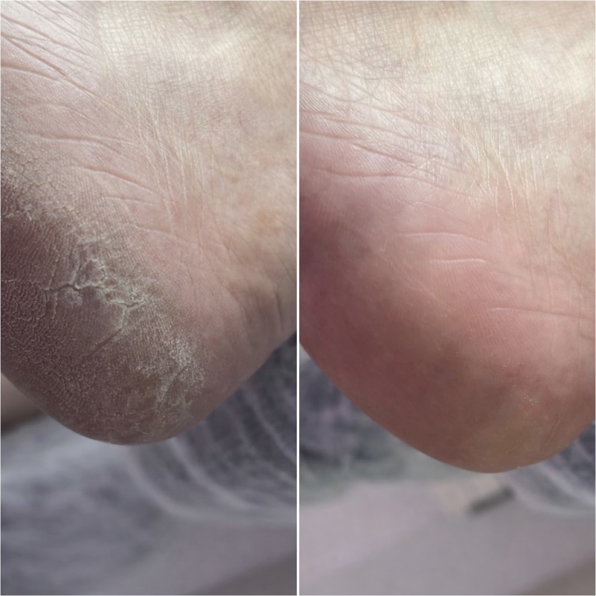 Medische pedicure - patalogische eelt